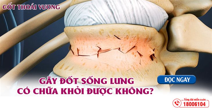 Gãy đốt sống lưng có chữa khỏi được không và giải pháp an toàn từ sản phẩm thiên nhiên