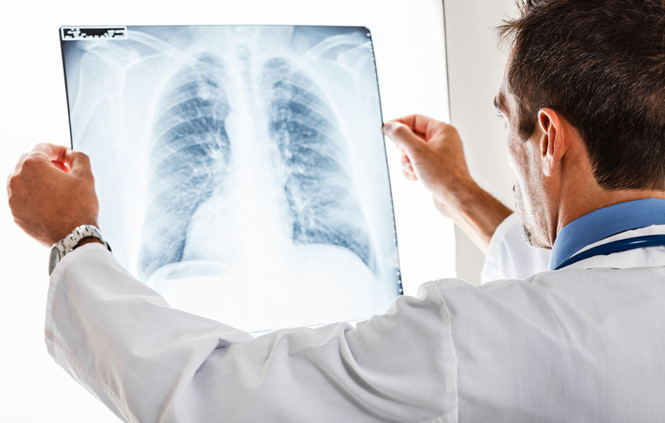 Chụp X-quang phát hiện nốt kích thước 1,5cm có nguy cơ tiến triển thành u phổi không?