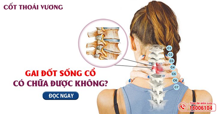 Gai đốt sống cổ có chữa được không? Dùng sản phẩm nào từ thiên nhiên để cải thiện hiệu quả?