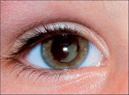 Phương pháp nào giúp chẩn đoán ung thư mắt? TÌM HIỂU NGAY!