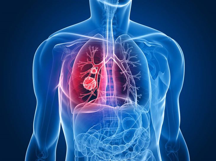 Người bị ung thư phổi gần 2 năm sử dụng sản phẩm thảo dược Oncolysin có được không?