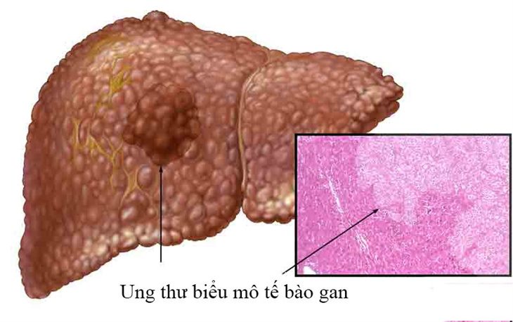 Người bị ung thư biểu mô tế bào gan dùng sản phẩm thảo dược Tumolung được không?