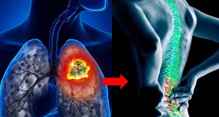 Bị u phổi di căn xương, sức khỏe suy kiệt sau điều trị, dùng sản phẩm thảo dược Tumolung được không?