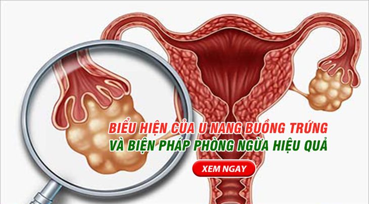 Biểu hiện của u nang buồng trứng ác tính và biện pháp phòng ngừa hiệu quả