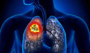 Người bị ung thư phổi tế bào nhỏ đã di căn cần điều trị như thế nào?