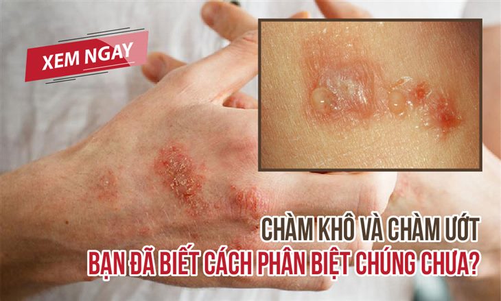 10. Câu Hỏi Thường Gặp Về Bệnh Chàm Ướt