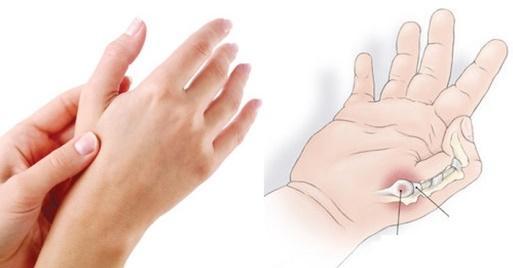 Tìm hiểu về bệnh viêm khớp ngón tay cái và giải pháp hay từ sản phẩm thảo dược