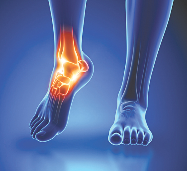 Viêm khớp cổ chân - Nguyên nhân và những biến chứng khó lường