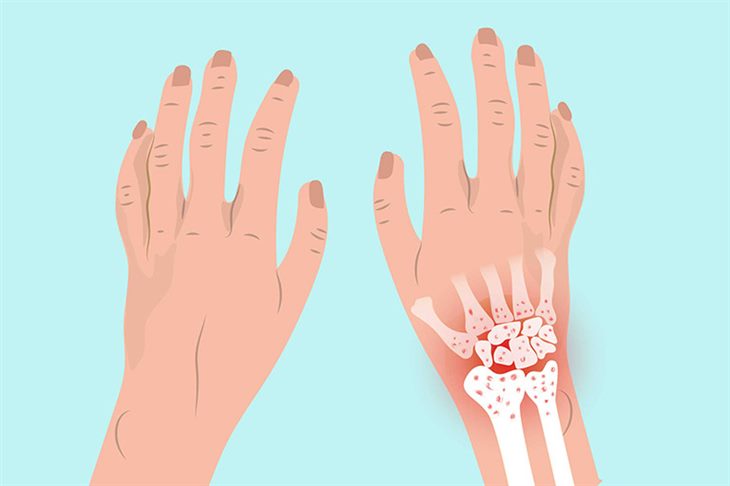 Tìm hiểu về thuốc điều trị viêm khớp cổ tay và những vấn đề cần lưu ý