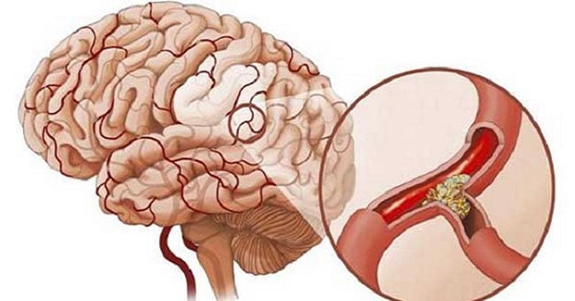 Rối loạn nhận thức sau tai biến mạch máu não