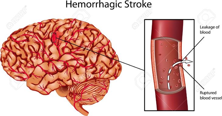 Phục hồi chức năng sau xuất huyết não và những thông tin cần biết