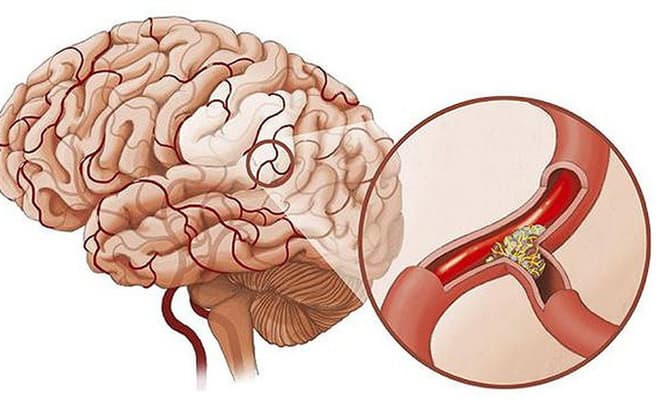 Giảm lưu lượng máu đến não do cục máu đông là nguyên nhân dẫn tới sa sút trí tuệ