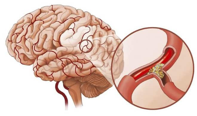 Tắc nghẽn mạch máu não là nguyên nhân chính gây suy giảm chức năng não bộ