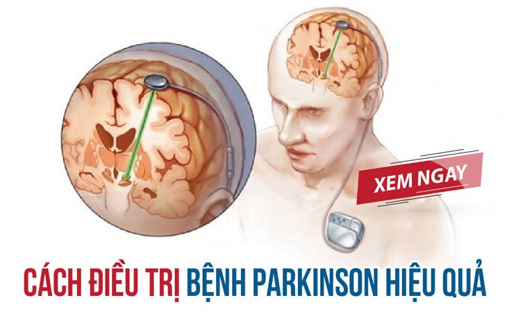 Đặt điện cực não sâu - Cách điều trị bệnh Parkinson hiệu quả, xem ngay!