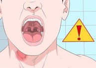 Viêm thanh quản và viêm mũi họng có mối liên quan gì đến nhau?