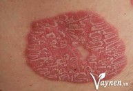 Vùng da nào dễ bị bệnh vẩy nến và cách xử trí ban đầu ra sao? Chuyên gia Trần Thị Thu Sang tư vấn