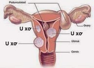 Chuyên gia giải đáp: Nguyên nhân gây u xơ tử cung là gì? 