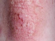 Bệnh eczema có lây không? Chuyên gia Nguyễn Thành giải đáp
