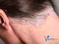 Các triệu chứng bệnh vẩy da như thế nào để dễ dàng nhận biết? Chuyên gia Nguyễn Hoàng Liên tư vấn