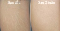Rạn da ở ngực phải làm sao? TS Nguyễn Thị Vân Anh tư vấn