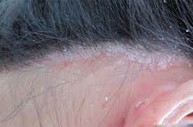 Bị vẩy nến da đầu điều trị như thế nào? Chuyên gia Nguyễn Thành tư vấn