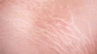 Bị rạn da giống rạn da sau sinh của phụ nữ là do nguyên nhân gì và điều trị ra sao?