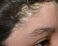 Cách chữa bệnh vẩy nến da đầu như thế nào? Ths. Nguyễn Thị Hiền tư vấn