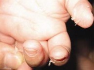 Bong tróc da ở đầu ngón tay có phải là biểu hiện của viêm da cơ địa không?