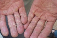 Bệnh viêm da cơ địa gây bong tróc và nứt đầu ngón tay điều trị như thế nào?