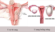 So sánh triệu chứng u xơ tử cung so với u nang buồng trứng?