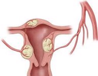 Nguyên nhân gây nhân xơ tử cung là gì? Cách phòng tránh bệnh này