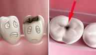 3 lời khuyên của chuyên gia Nguyễn Hồng Hải giúp bạn cải thiện sâu răng nhanh chóng
