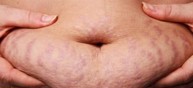 Rạn da bụng có thể chữa khỏi được không? Chuyên gia Nguyễn Thị Hiền tư vấn