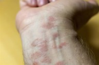 Bệnh eczema là bệnh gì? Chuyên gia Nguyễn Thành giải đáp