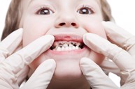 Trẻ bị sâu răng phải làm sao? Chuyên gia Phạm Hưng Củng tư vấn