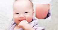 Trẻ bị chàm sữa nên bôi thuốc gì? Chuyên gia Nguyễn Thành tư vấn