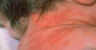 Trẻ thường bị nổi mẩn sau gáy có phải dấu hiệu viêm da cơ địa không? TS Nguyễn Thị Vân Anh tư vấn