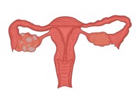 Bệnh u nang buồng trứng u xơ tử cung là gì? Chuyên gia tư vấn