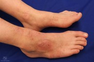 Triệu chứng của viêm da cơ địa có phải là ngứa dữ dội, chảy nước vàng ở chân?