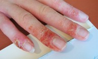 Bệnh chàm khô đầu ngón tay phân biệt với vẩy nến, á sừng như thế nào? Điều trị có khác nhau không?