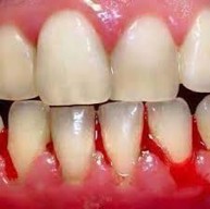 Quá trình chữa chảy máu chân răng, hôi miệng của anh Nguyễn Thế Thiện (ĐT:0912459871)