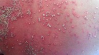 Nên chăm sóc da vào mùa nắng nóng như thế nào để hạn chế những triệu chứng vẩy nến?