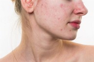 Viêm da mặt nổi mụn thì nên điều trị như thế nào? Chuyên gia Nguyễn Thị Hiền tư vấn
