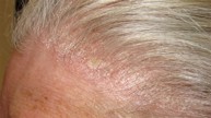 Da đầu bị đóng vảy đỏ là do nguyên nhân gì và điều trị ra sao? Chuyên gia Trần Quang Đạt tư vấn