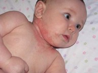 Trẻ bị nổi ban đỏ trên mặt, dễ tái phát có phải viêm da dị ứng không?