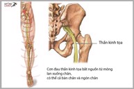 Người bị đau lưng kéo dài dùng Cốt Thoái Vương có hiệu quả không? Chuyên gia  Dương Trọng Hiếu phân tích