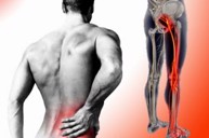 Tình trạng đau nhức từ hông xuống bắp chân có phải biểu hiện đau dây thần kinh tọa không?