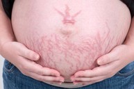 Tình trạng rạn da khi mang thai xuất hiện vào tháng thứ mấy? Cải thiện bằng Babolica được không?