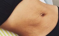 Tình trạng rạn da sau sinh ảnh hưởng đến hoạt động tình dục như thế nào?