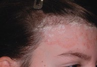 Làm sao để phân biệt triệu chứng của vảy nến da đầu với gầu hay các bệnh về da đầu khác?